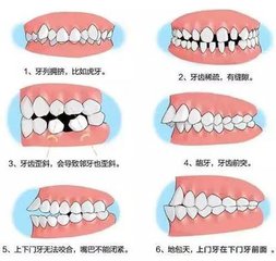 牙齒錯頜畸形