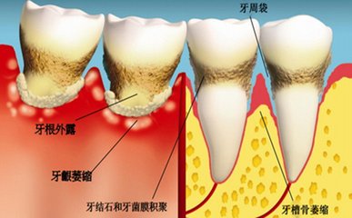 牙周病有哪些症狀