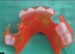 可摘式功能性保持器