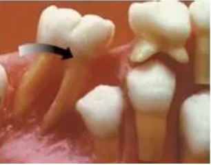 什麽(me) 是間隙保持器