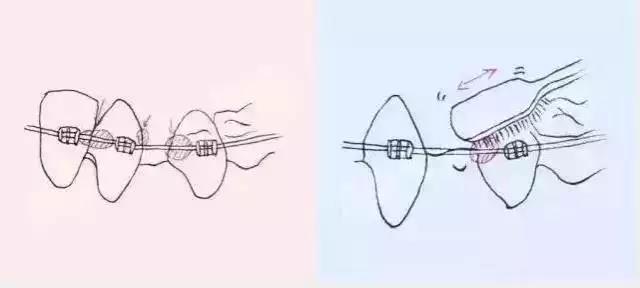 彈簧周圍和拔牙的間隙