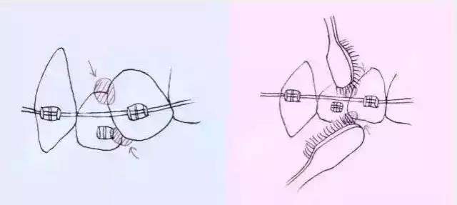 牙齒擁擠矯正刷牙