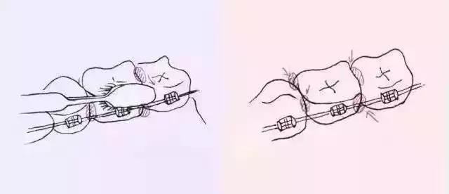 戴有帶環的磨牙