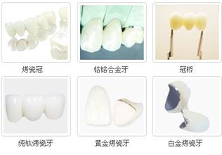 烤瓷牙分類