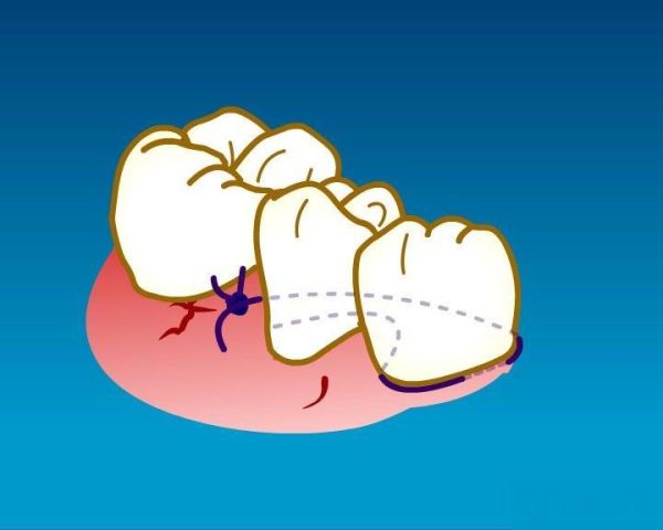 牙周炎怎麽(me) 辦