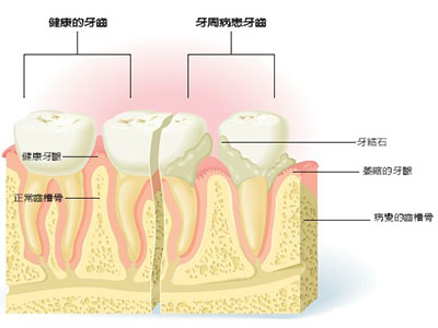  牙齒鬆動治療