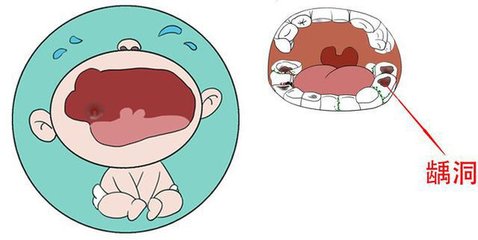 寶寶乳牙蟲牙治療