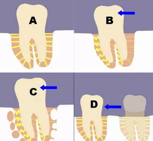 牙齒矯正會(hui) 造成牙齒鬆動嗎