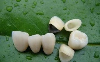 鈷鉻烤瓷牙大概多少錢？