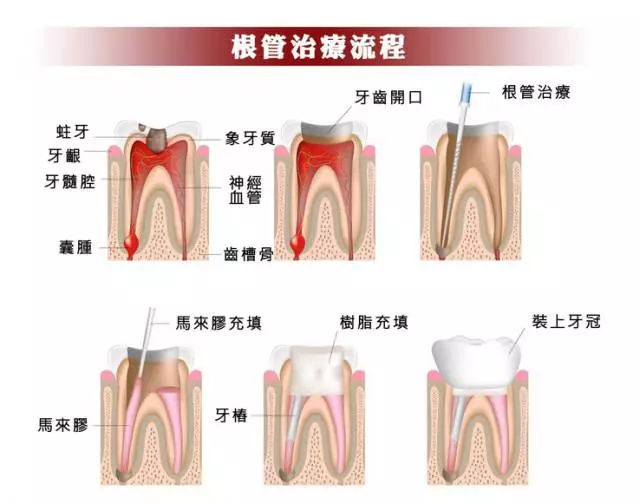 哪些牙齒需要做根管治療