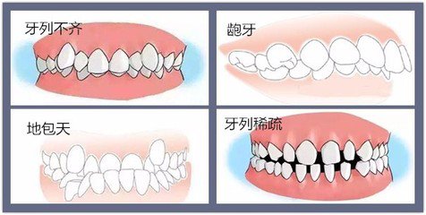 深圳牙齒矯正收費標準
