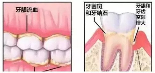 牙周病的症狀