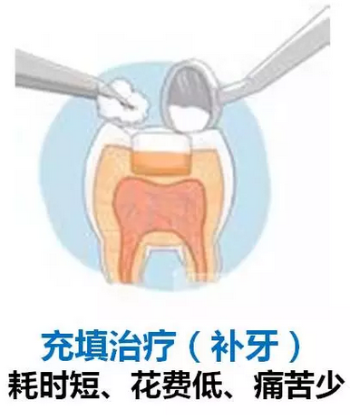 為(wei) 什麽(me) 補牙的時候要先磨牙？