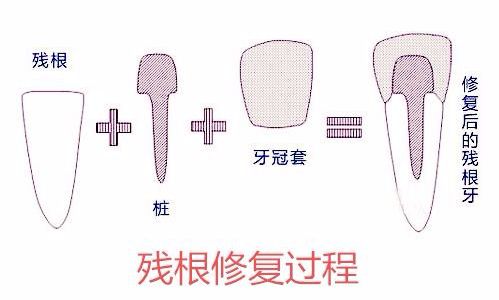 根管治療後為(wei) 什麽(me) 要“打樁”