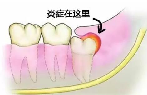 智齒一般有哪些危害？