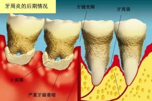 牙周治療步驟