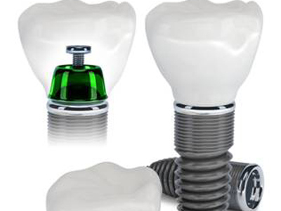 種植牙選擇選擇？貴的還是便宜的？