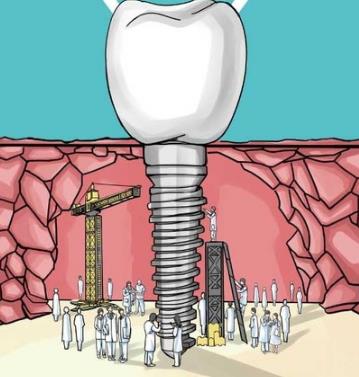 全口牙種植後注意事項