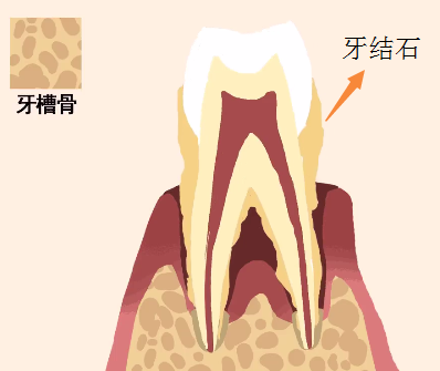 牙齒矯正之前為(wei) 什麽(me) 要治療牙周病？