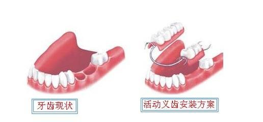 深圳安裝假牙要多少錢
