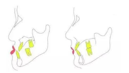 牙齒畸形麵型不好
