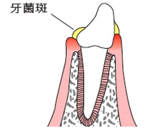 深圳牙齒鬆動修複多少錢