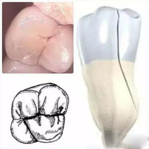 牙隱裂怎麽(me) 治療？