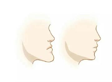 整牙對臉型有影響嗎