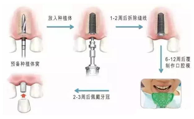 做種植牙要多長時間