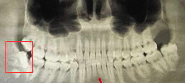 牙齒矯正一定要拔智齒嗎