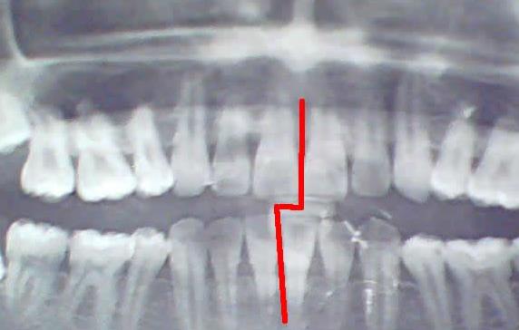 牙齒矯正會(hui) 失敗嗎