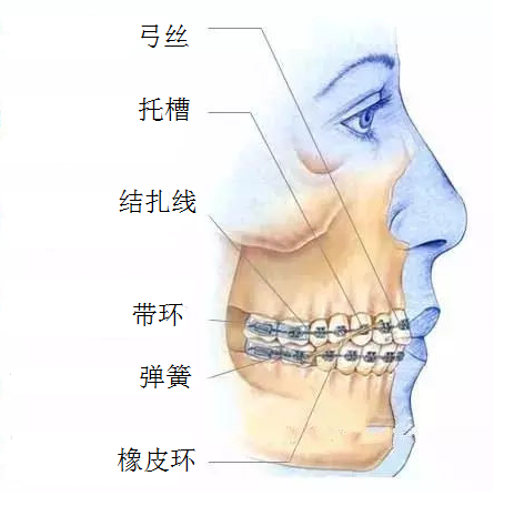 傳(chuan) 統矯正器是組成