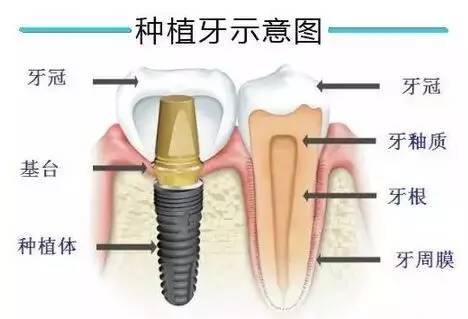 種植牙會(hui) 影響核磁檢查嗎