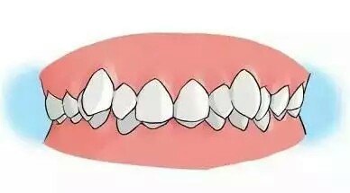 牙齒擁擠一般要拔幾顆牙