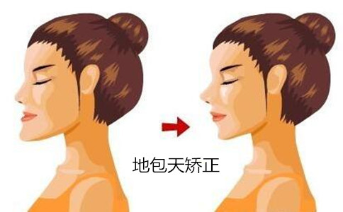 地包天牙套矯正多少錢