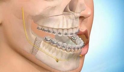 地包天怎麽(me) 矯正比較好