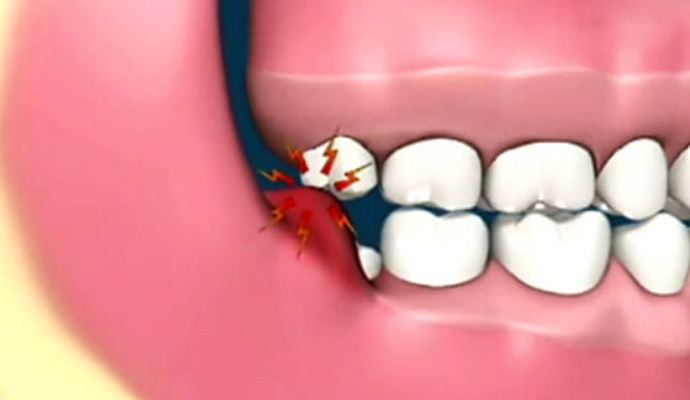 看牙疼需要多少錢