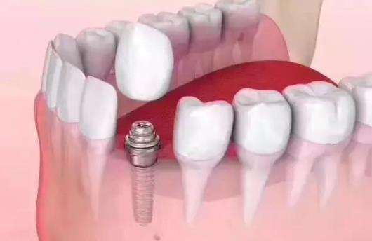 種植牙的人工牙根