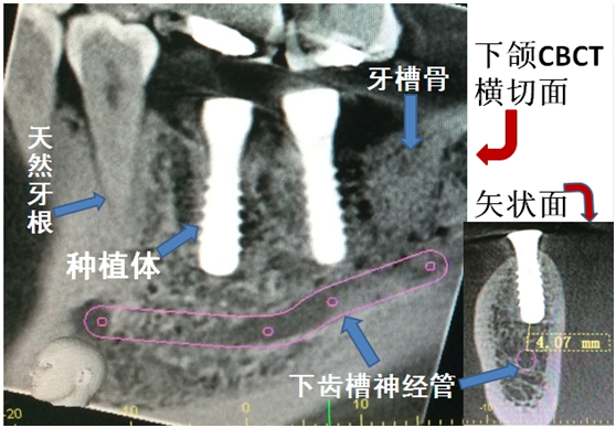 國產(chan) 種植牙和進口種植牙的區別