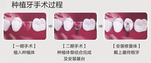 牙槽骨很薄可以做種植牙嗎