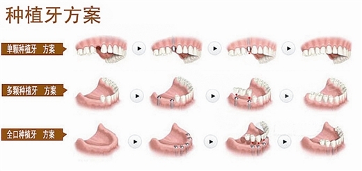 種牙周期要多長