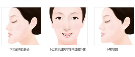 乳牙反合治療後會(hui) 複發嗎
