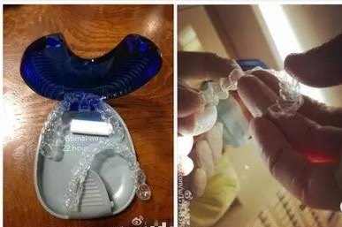 隱形牙套矯正注意事項