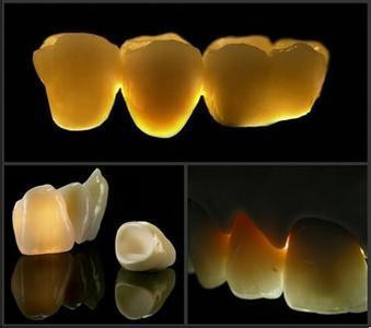 多顆烤瓷牙的價(jia) 格