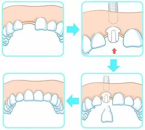 傳(chuan) 統種牙和即刻種牙的區別