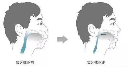 牙齒擁擠怎麽(me) 解除