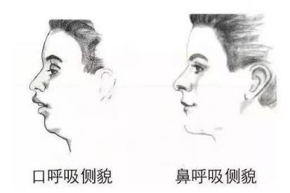 牙齒矯正後反彈