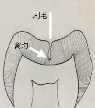 窩溝封閉幾歲做比較好