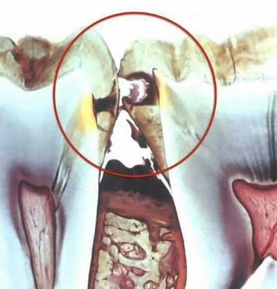 常見的牙齒問題，你有幾個(ge) 