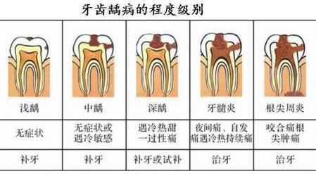 根管治療注意事項